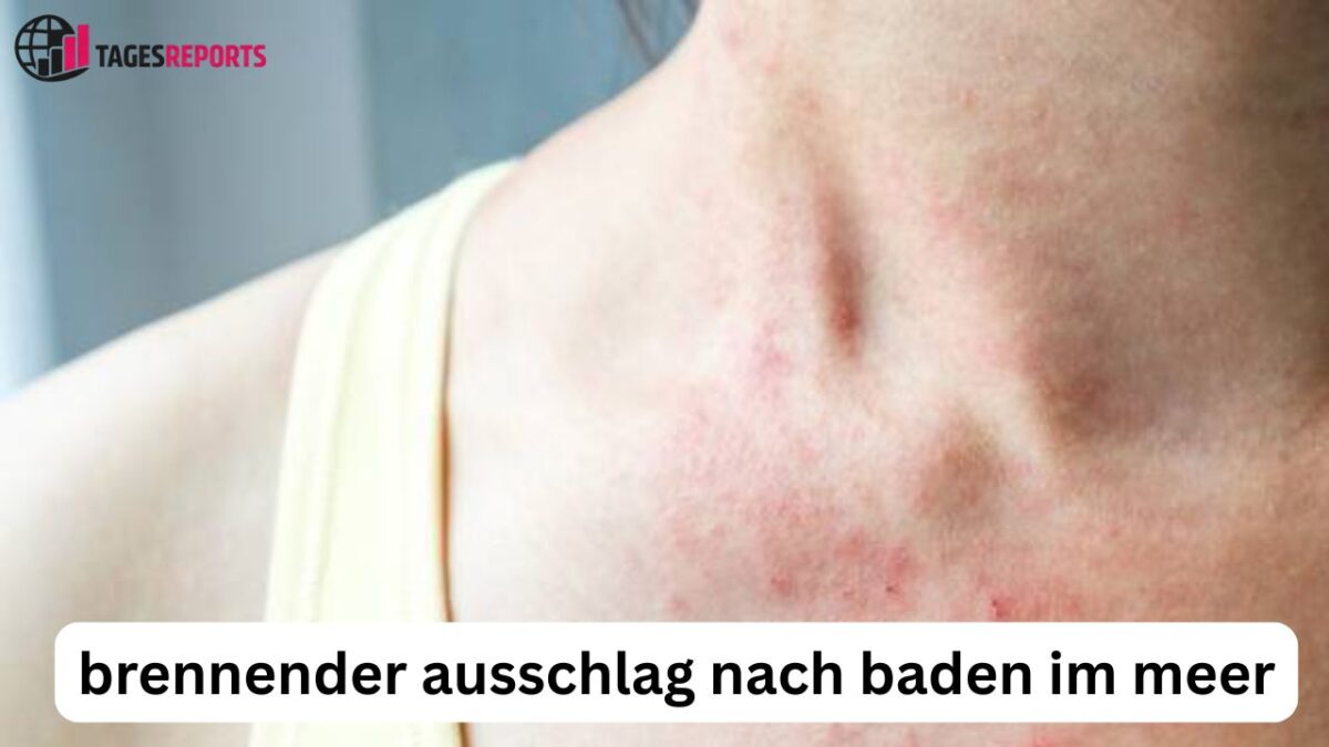 Brennender Ausschlag nach Meerbad