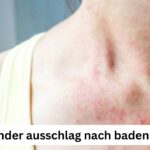 Brennender Ausschlag nach Meerbad