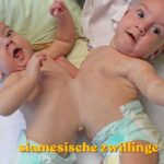 Siamesische Zwillinge
